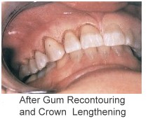 After Gum Contouring and Crown Lengthening