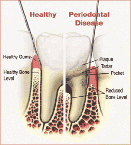 laser-dentistry-la-jolla