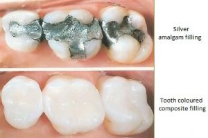 metal-free-dentist-san-diego