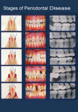 Periodontal Disease Treatment San Diego