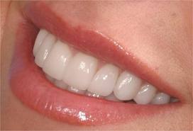 Getting Started with Veneers in San Diego