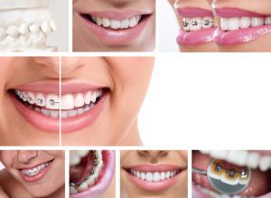 Braces FAQs San Diego