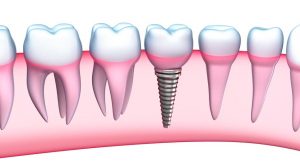 implant illustration