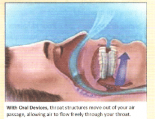 Understanding the Causes of Sleep Apnea