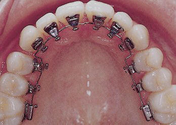 lingual_braces