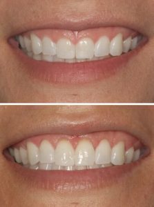 Benefits of Gum Contouring and Gum Sculpting