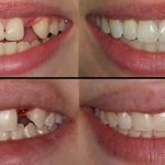 dental-implant-before-and-after