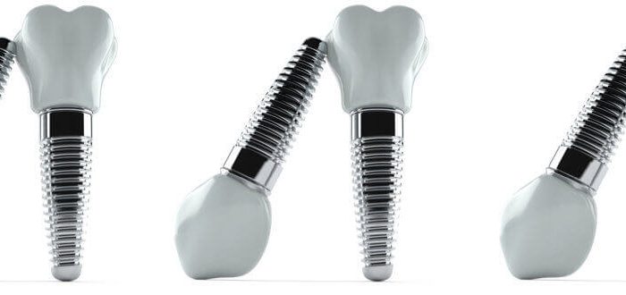 dental implants