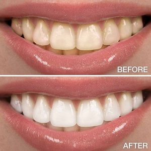 Before and After - Teeth Whitening Example