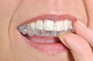 Clear Aligners San Diego